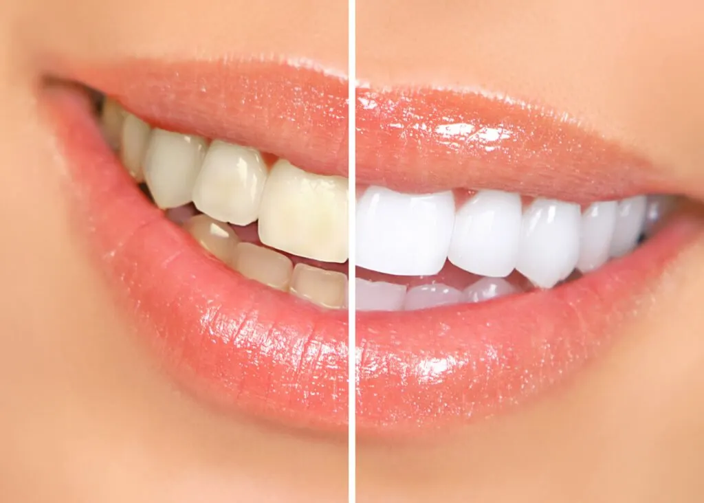 Teeth-Whitening Kit